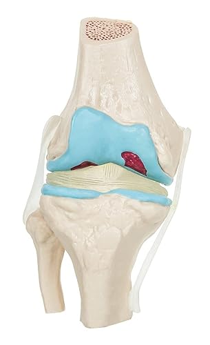 4 Stage Osteoarthritis Anatomical Knee Model, Model On Base, with Detailed Study spancare
