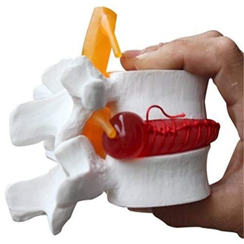 Spancare Human Lumbar Demonstration Model with Herniating Disc, Varied Textures spancare