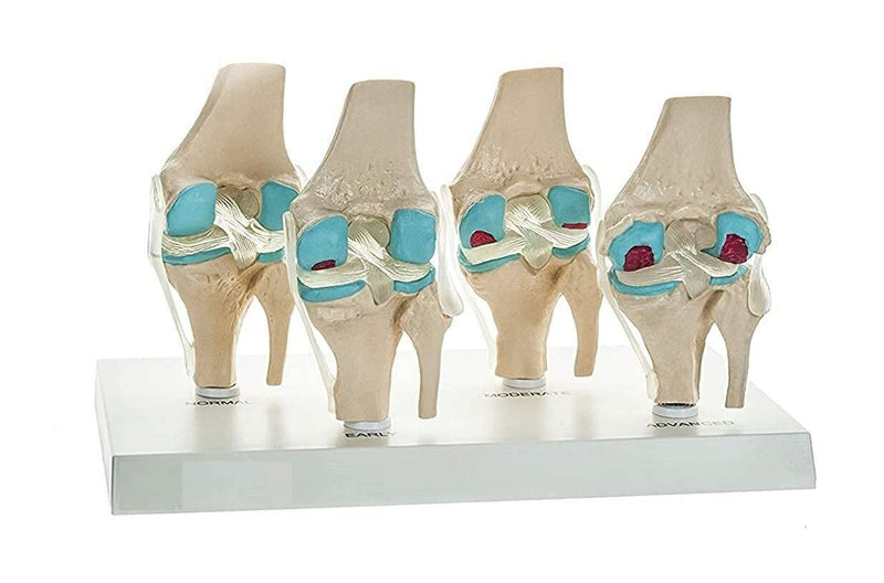 Spancare 4 Stage Osteoarthritis Anatomical Knee Model, Model On Base, with Detailed Study spancare
