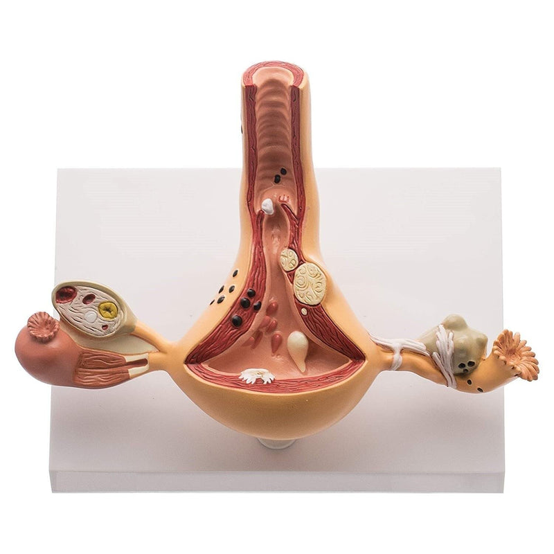 Spancare Ovary and Uterus Female Reproductive Organ Anatomical Model Common Abnormalities spancare