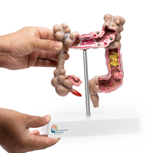 Human Intestine Anatomical Model with Pathologies – Premium Quality